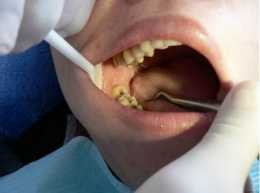 拔完智齒唾液分泌增加是什麼原因？