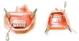 怎麼區分齙牙是骨性的還是牙性？