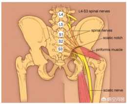 坐骨神經痛和腰椎間盤突出有什麼區別？