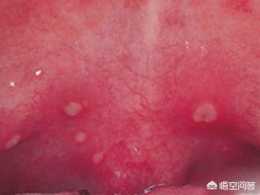 小兒手足口病與皰疹的區別是什麼？怎麼治療？