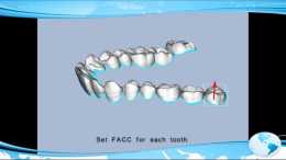 帶牙套是一個怎樣的過程?對你的生活有什麼影響?