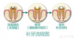 什麼叫補牙？