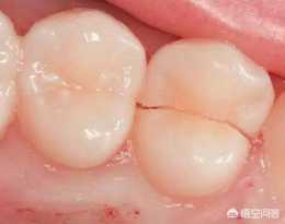 牙隱裂後該如何治療?