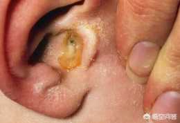 耳朵流膿是怎麼回事?