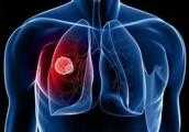 早期肺癌手術後復發一般在第幾年？